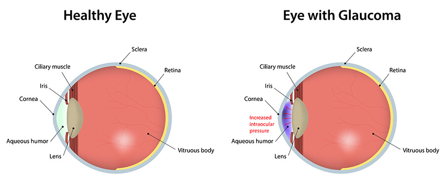 diagram of healthy eye and eye with glaucoma