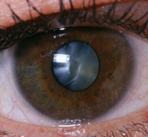 Eye With Cataracts