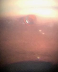 Cypass Microstent Inserted In Eye