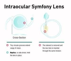 Intraocular Symfony Lens