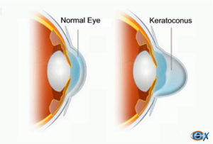 Normal Eye Compared to Keratoconus Eye