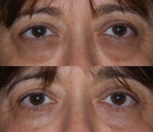 Lower Eyelid Blepharoplasty Before and After