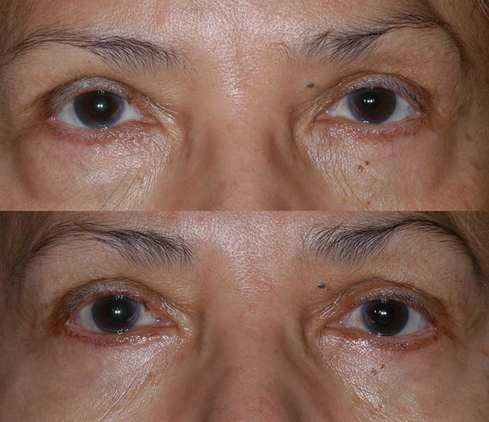 Lower Eyelid Blepharoplasty Example #1