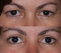 UPPER LID BLEPHAROPLASTY