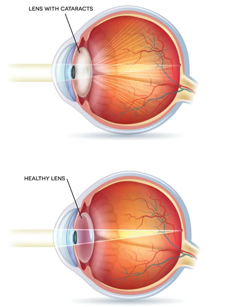 Chart illustrating a healthy lens to one with a cataract