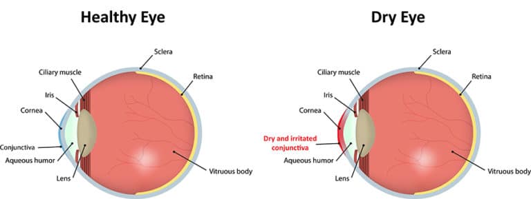 Chart illustrating a healthy eye compared to one experiencing dry eye