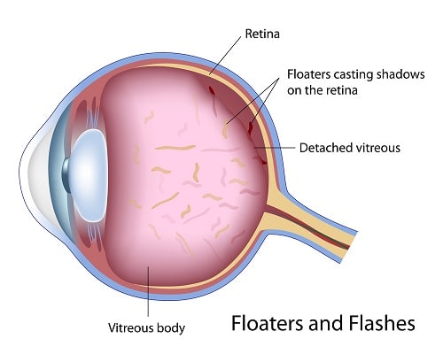 Chart showing how floaters and flashes affect an eye