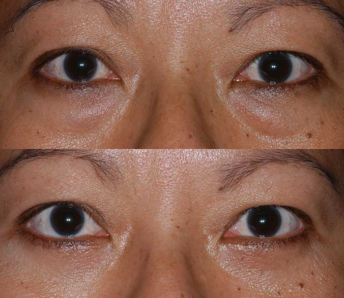 Before and After Lower Eyelid Surgery / Blepharoplasty