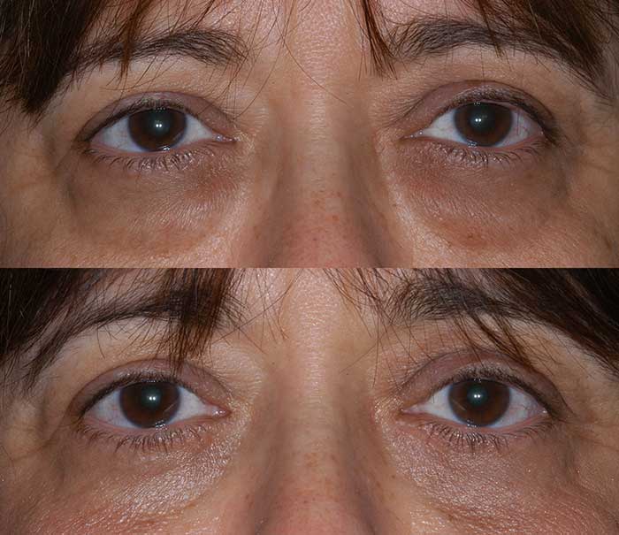 Before and After Lower Eyelid Surgery / Blepharoplasty