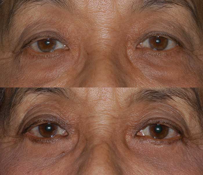 Before and After Lower Eyelid Surgery / Blepharoplasty