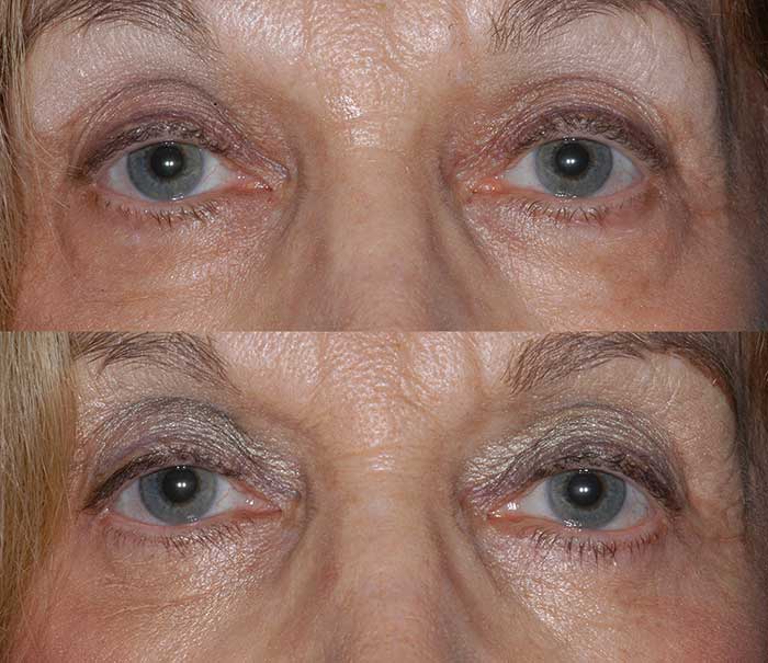 Before and After Lower Eyelid Surgery / Blepharoplasty