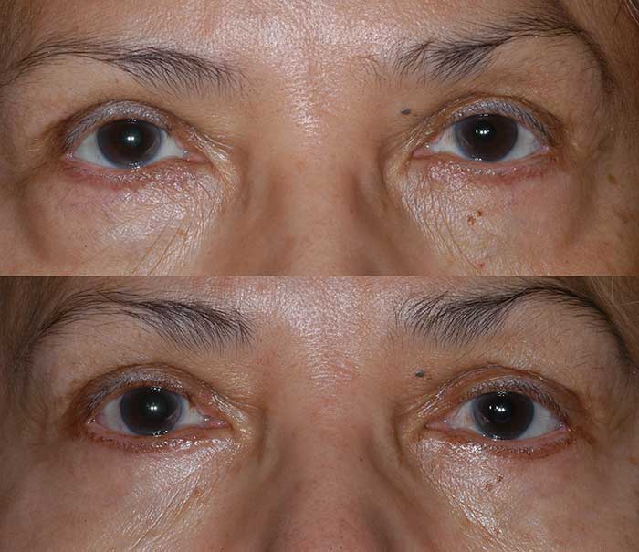 Before and After Lower Eyelid Surgery / Blepharoplasty