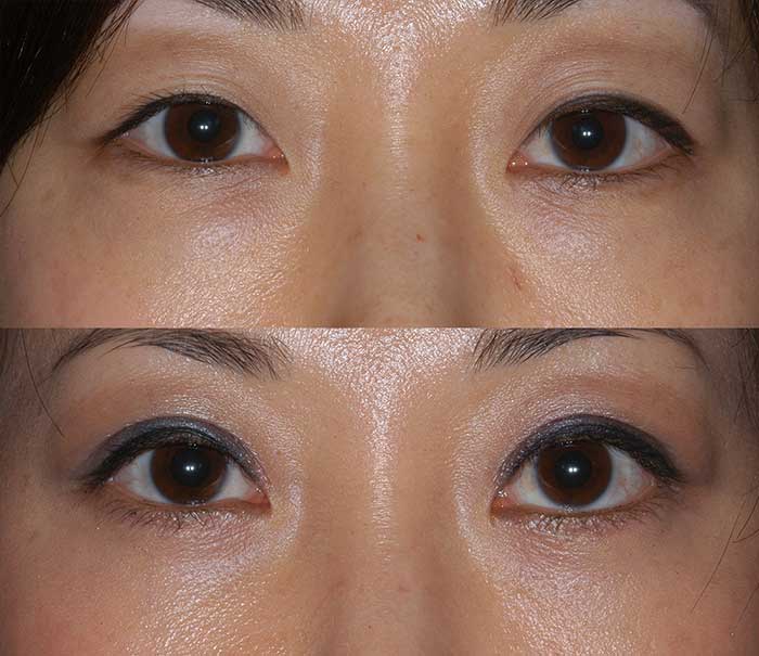 Before and After Lower Eyelid Surgery / Blepharoplasty