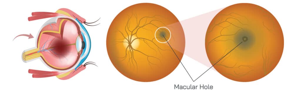 Chart Illustrating a Macular Hole