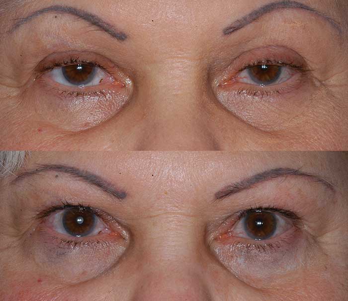 Before and After Ptosis Repair Eyelid Surgery / Blepharoplasty