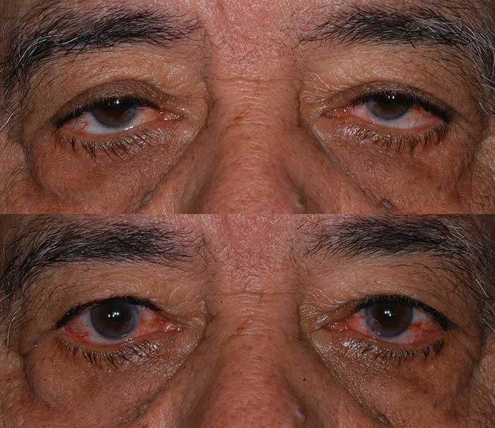 Before and After Ptosis Repair Eyelid Surgery / Blepharoplasty