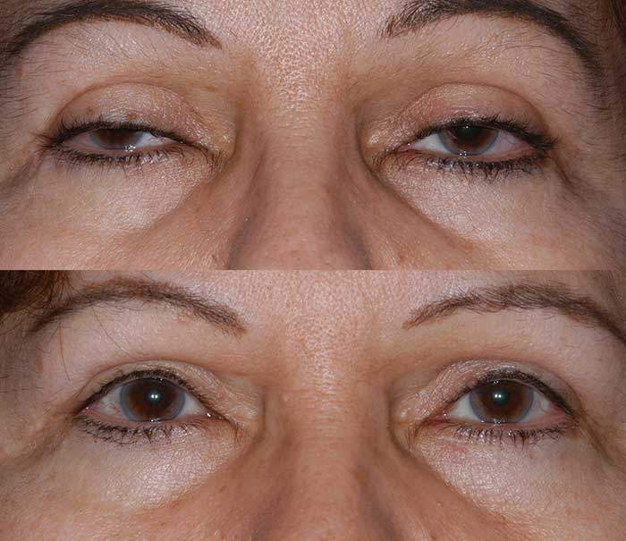 Before and After Ptosis Repair Eyelid Surgery / Blepharoplasty