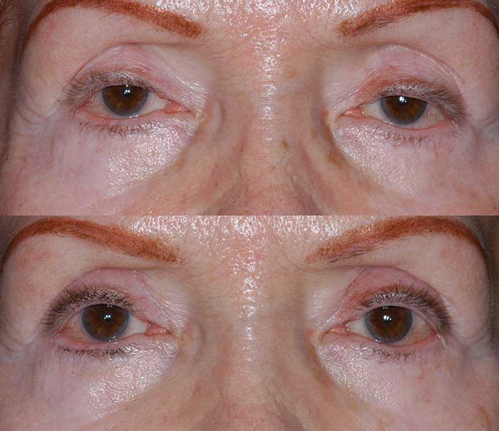 Before and After Ptosis Repair Eyelid Surgery / Blepharoplasty