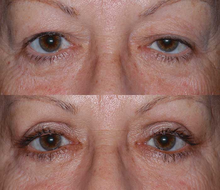 Before and After Ptosis Repair Eyelid Surgery / Blepharoplasty