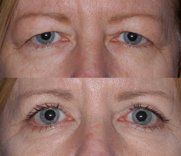 Before and After Upper Eyelid Surgery / Blepharoplasty