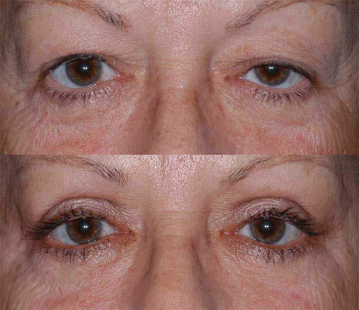 Before and After Upper Eyelid Surgery / Blepharoplasty