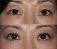 UPPER LID BLEPHAROPLASTY