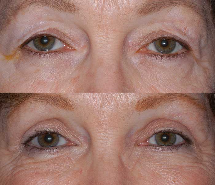 Before and After Upper Eyelid Surgery / Blepharoplasty