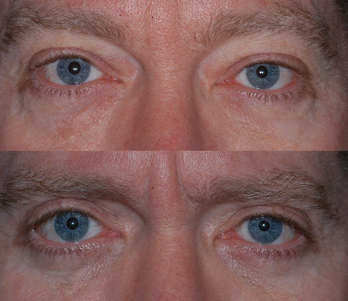 Before and After Upper Eyelid Surgery / Blepharoplasty