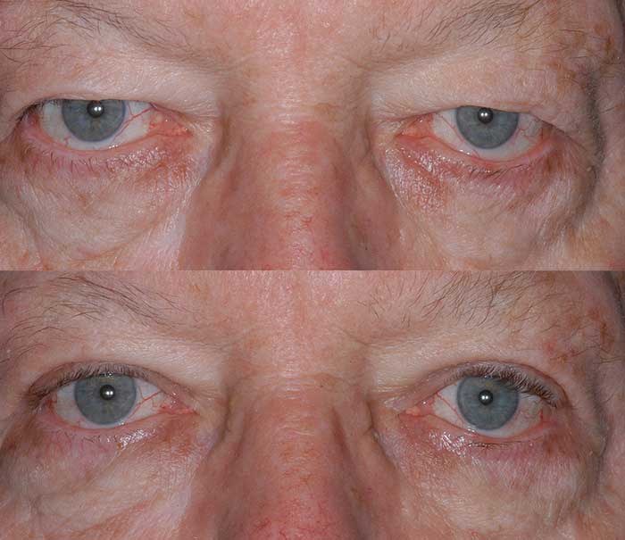 Before and After Upper Eyelid Surgery / Blepharoplasty