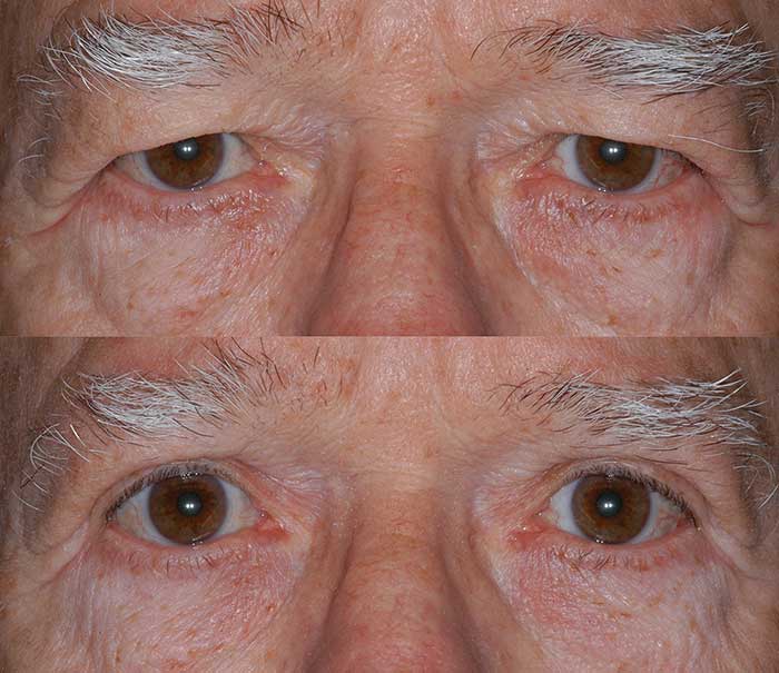 Before and After Upper Eyelid Surgery / Blepharoplasty