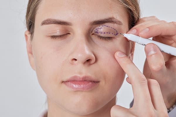 Woman being prepped for upper blepharoplasty